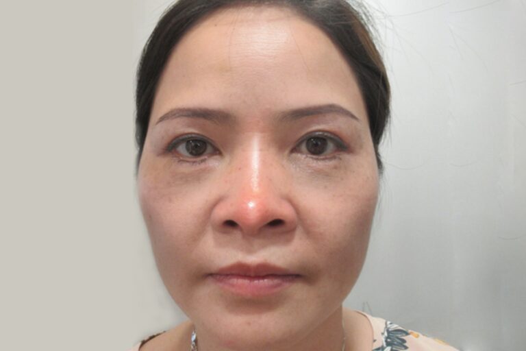 Dấu hiệu nhận biết nâng mũi bị bao xơ