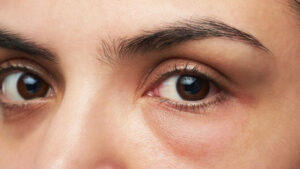 Cách khắc phục quầng thâm mắt và các phương pháp điều trị