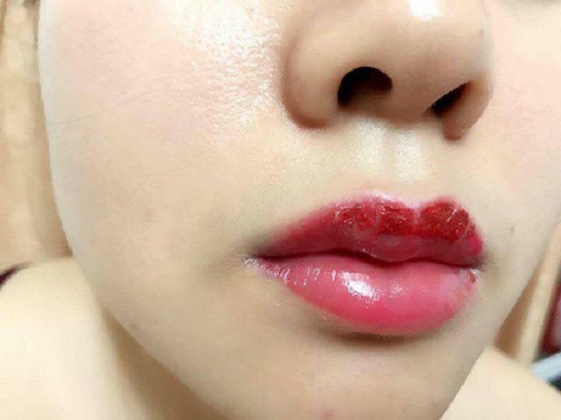 Nguyên nhân gây sẹo sau phun môi
