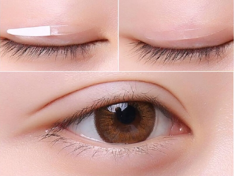 Nhấn mí hoặc cắt mí