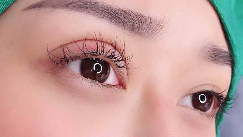 Nước mắm có ảnh hưởng gì đến vết thương sau cắt mí?