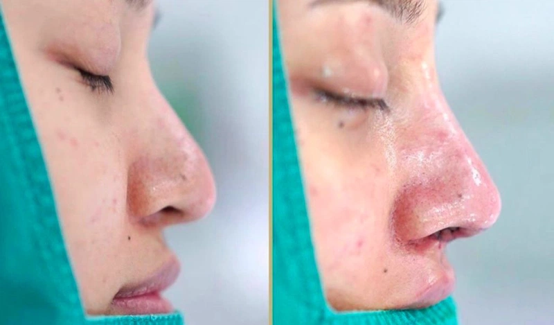 Thời gian cắt chỉ sau nâng mũi