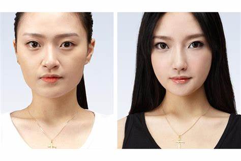 Tổng quan về phẫu thuật hạ gò má