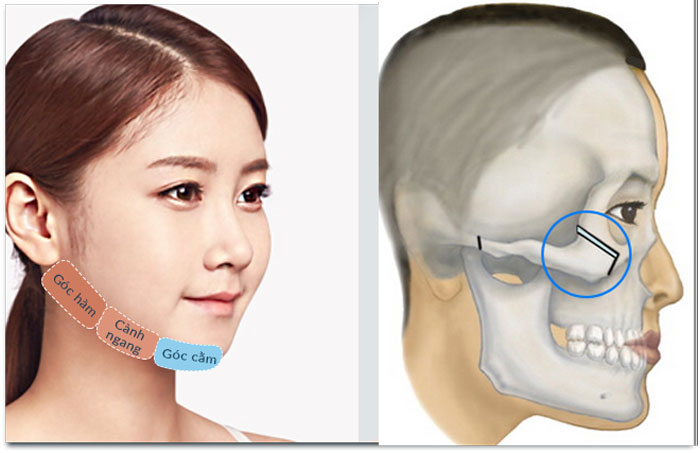 Hiệu quả hạ gò má có kéo dài vĩnh viễn không?