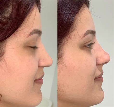 Vì sao cần chờ đợi 5-7 ngày để cắt chỉ?