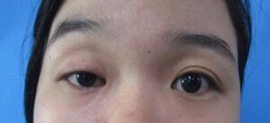 Mắt một bên 2 mí một bên 1 mí là như thế nào?